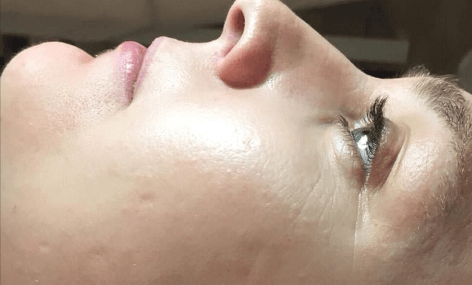După tratamentul Dermapen cu Microneedling la Slim & Beauty by MC
