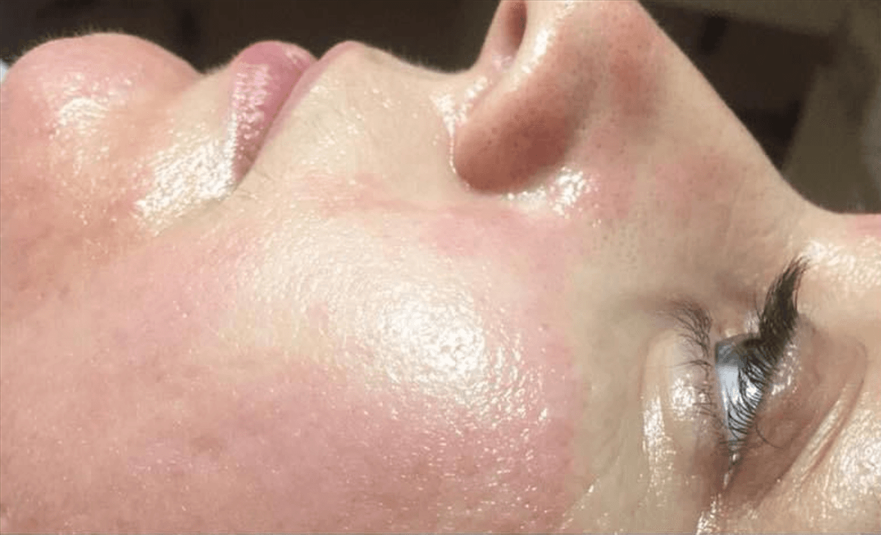 Înainte de tratamentul Dermapen cu Microneedling la Slim & Beauty by MC